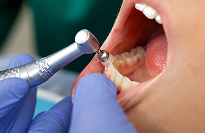 2.プロによるクリーニングでむし歯・歯周病の原因を削減