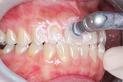 1.歯のクリーニング